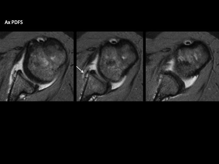 Figure 5 for case Glenoid Avulsion Glenohumeral Ligament